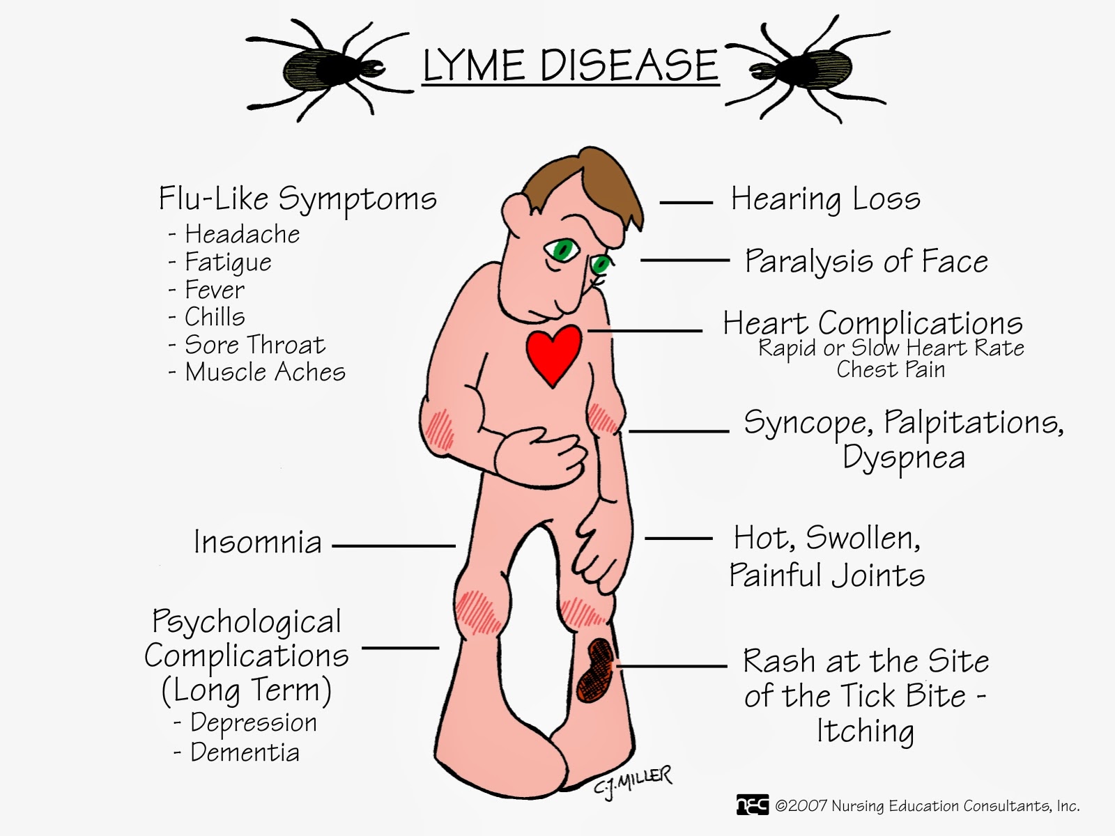 blog-Lyme-Disease-symptoms